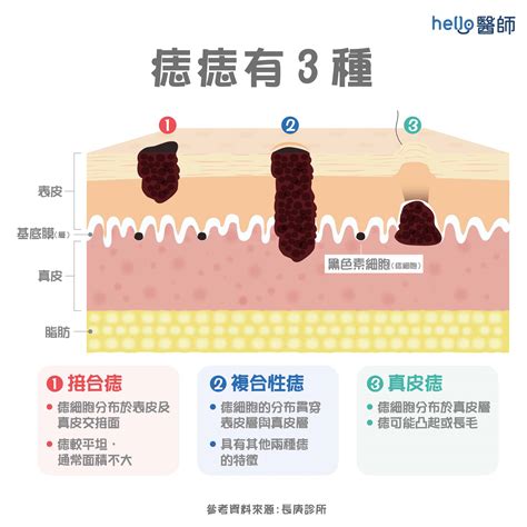 臉頰長痣代表什麼|痣形成的原因？痣長毛、痣變多變大是痣病變？5招判別